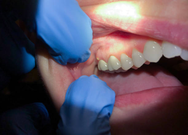 Best Emergency Dental Services for Seniors in Cameron, MO