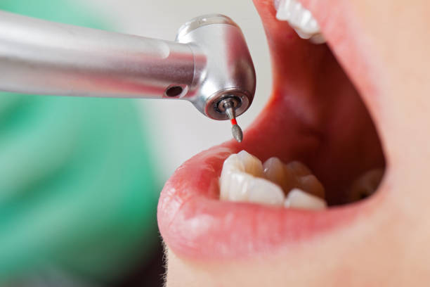 Best Emergency Root Canal Treatment in Cameron, MO